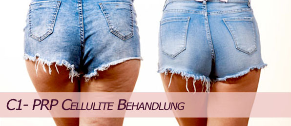 PRP Behandlung im PRP Zentrum Wien Cellulitebehandlung Cellulitis Cellulitefrei Mesotherapie