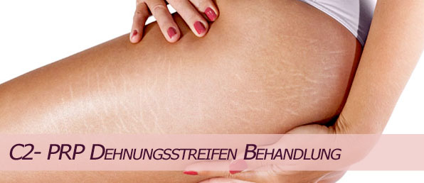 PRP Behandlung im PRP Zentrum Wien Cellulitebehandlung Cellulitis Dehnungsstreifen Mesotherapie