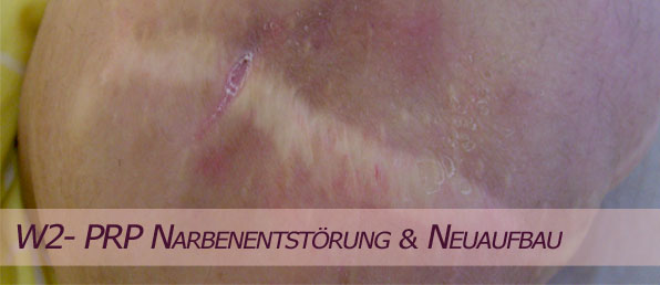 PRP Behandlung im PRP Zentrum Wien Narbenbehandlung Narbenentst�rung beschleunigte Wundheilung