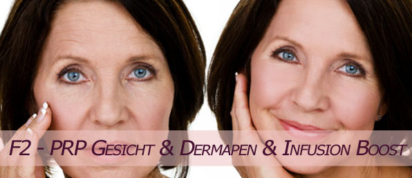 PRP Behandlung im PRP Zentrum Wien Gesichtsbehandlung Vampire Lift Mesotherapie Hyaluron Infusionstherapie
